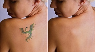 tattoo removal clinic in Westlake Village